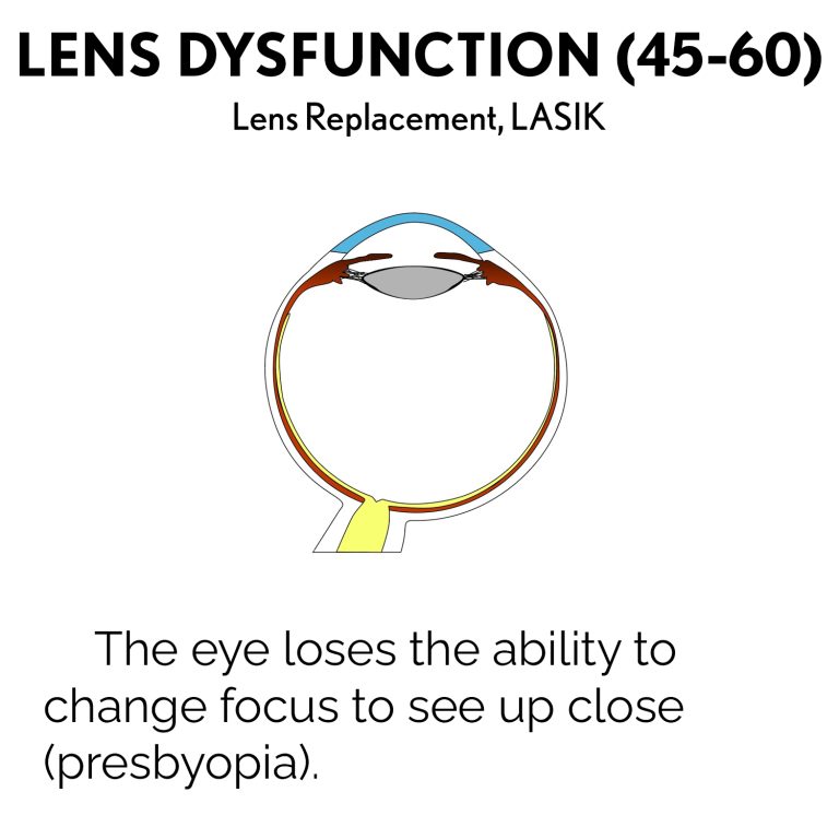 Lens-Dysfunction